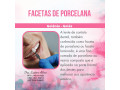 facetas-porcelana-goiania-goias-small-0