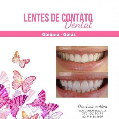 facetas-porcelana-goiania-goias-big-2