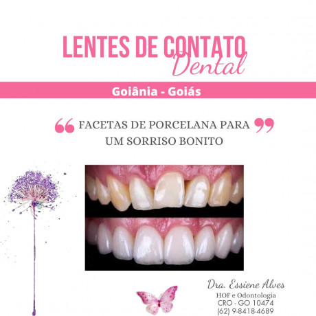 facetas-porcelana-goiania-goias-big-4