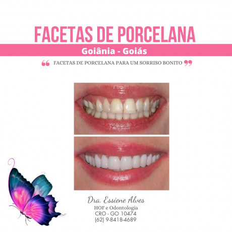 facetas-porcelana-goiania-goias-big-3